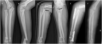 Type III Monteggia Injury With Ipsilateral Distal Forearm Fracture in a Child: A Case Report